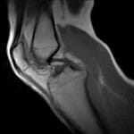 knee pain vancouver treatment