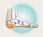 heel pain vancouver foot otrthotics