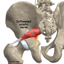 vancouver sciatica treatment inflamed sciatic nerve