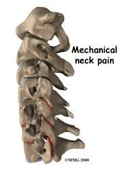 neck pain vancouver physiotherapist