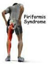 sciatica vancouver treatment piriformis muscle