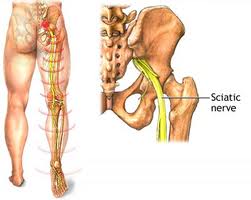 sciatic nerve pain treatment