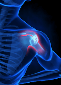 sports physiotherapy vancouver