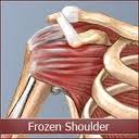 frozen shoulder treatment vancouver